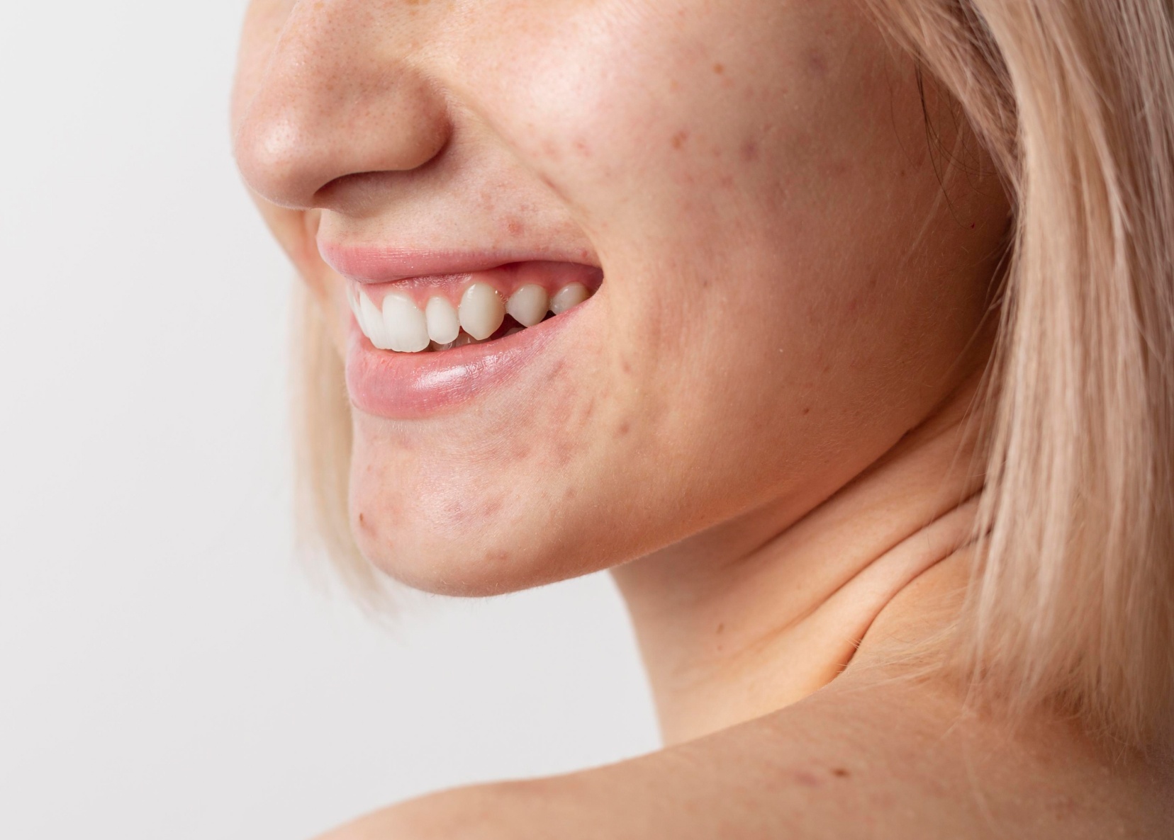 Cicatrices d'acné | Laser pour cicatrice acné prix | Esthétique | Dr Paitel | Le Cannet-des-Maures