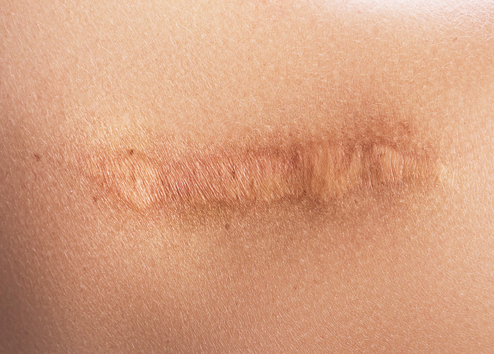 Cicatrices | Laser vasculaire cicatrice | Médecine esthétique | Dr Paitel | Le Cannet-des-Maures