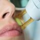 L’épilation laser pour traiter l’hirsutisme